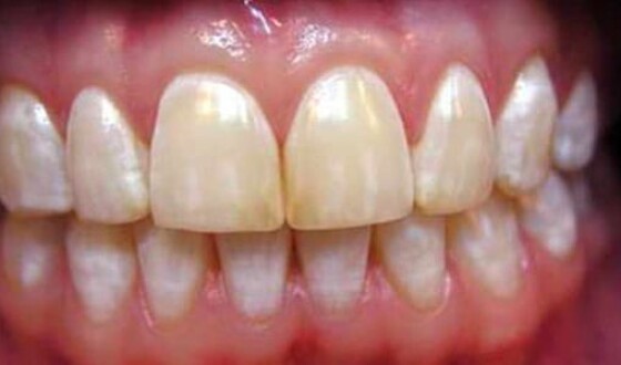 Желтая точка на зубе &#8211; причины, что делать?
