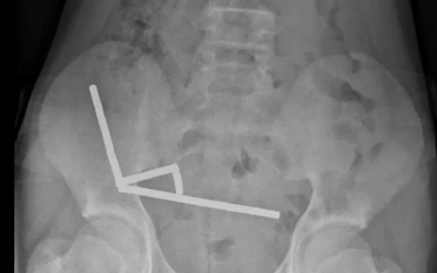 У Новій Зеландії у хлопчика видалили близько 100 магнітів куплених онлайн з Китаю