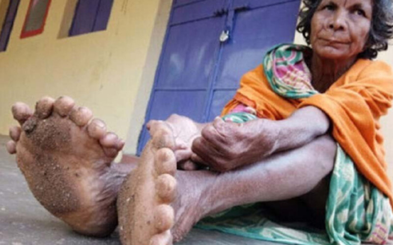 Жительница Индии установила мировой рекорд по количеству пальцев