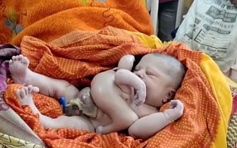 Жінка в Індії народила дитину з вісьмома кінцівками