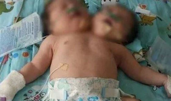 Від немовляти з двома головами, народженого в Узбекистані, відмовилися батьки